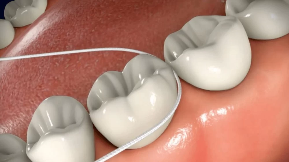How to Avoid Tooth Decay with Proper Flossing Techniques: Expert Tips