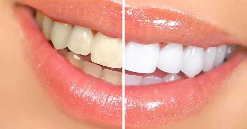 Understanding Causes of Tooth Discoloration and Effective Ways to Fix It