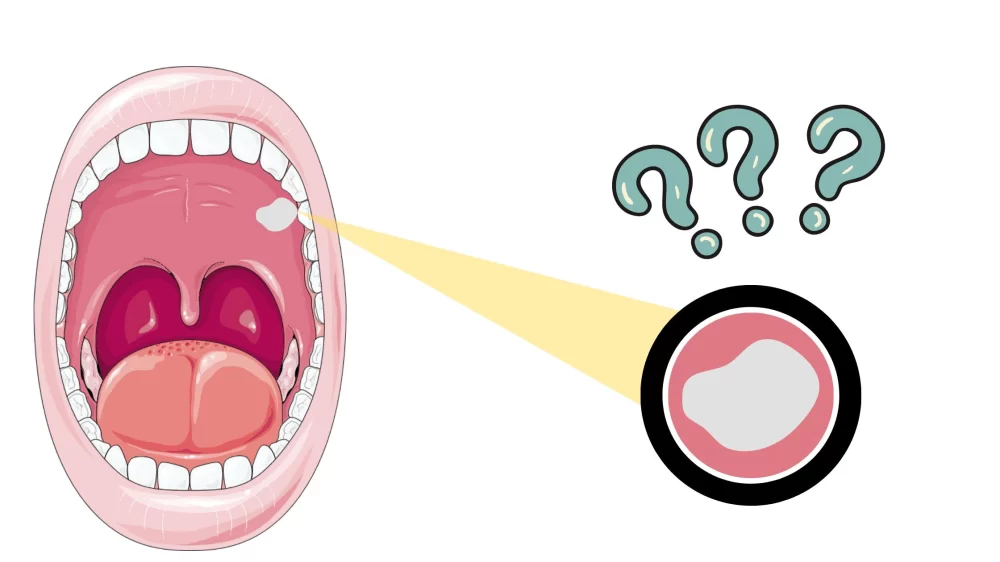 Understanding What Causes White Patches in Mouth and How to Address Them