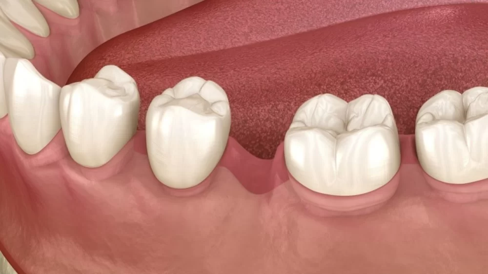 How to Stop Teeth from Shifting After Tooth Loss: Effective Strategies and Solutions