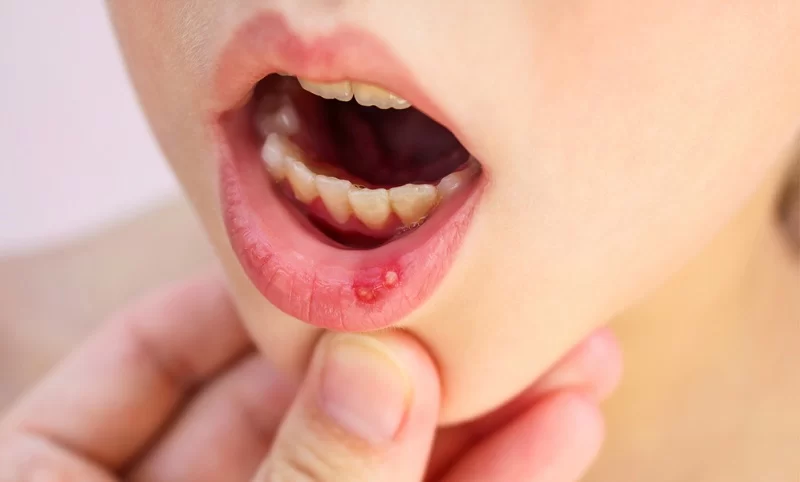 Effective Ways to Treat Oral Ulcers Naturally for Faster Healing