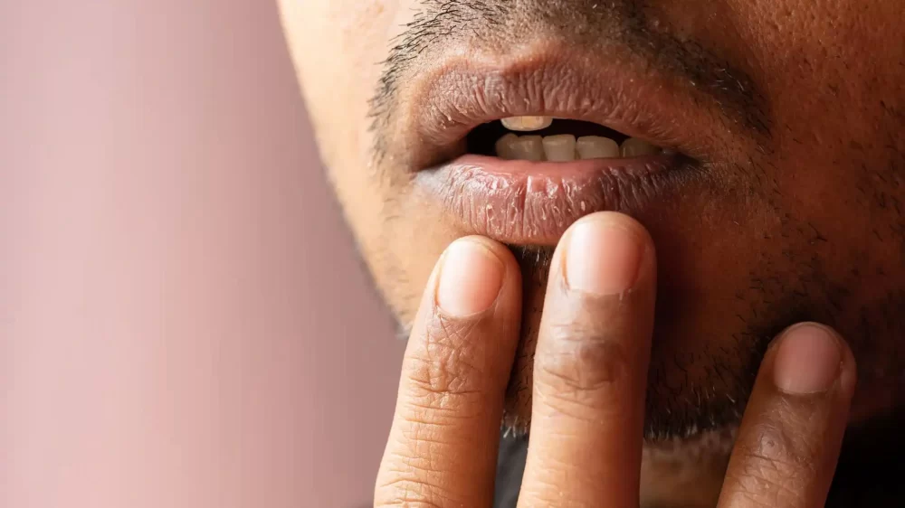 Effective Treatment for Dry Mouth Caused by Medication: Natural and Professional Solutions