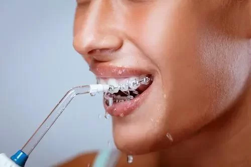 Best Floss for Braces and Sensitive Gums: Effective and Gentle Oral Care Solutions