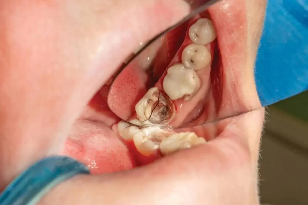 Understanding What Causes Teeth to Crack and Chip Easily: Causes and Prevention