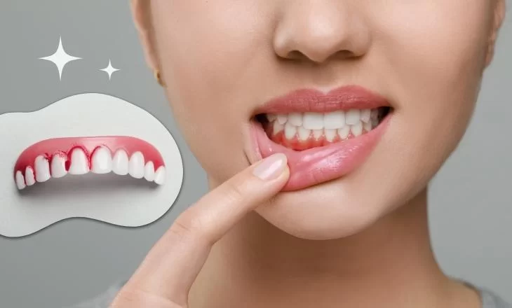 Natural Remedies for Bleeding Gums: Effective Solutions and Expert Tips