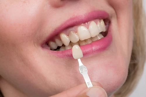 Causes of Tooth Pain After Dental Crown Placement: In-depth Analysis and Solutions