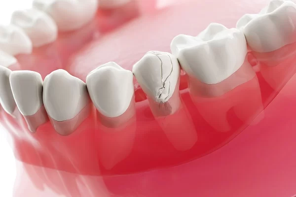 How to Fix a Chipped Tooth Without a Dental Visit: Real Solutions and Risks Explained