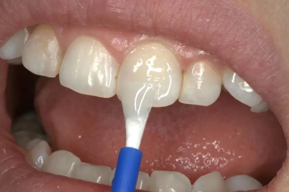 How to Stop Tooth Sensitivity After Filling: Practical Solutions and Expert Advice