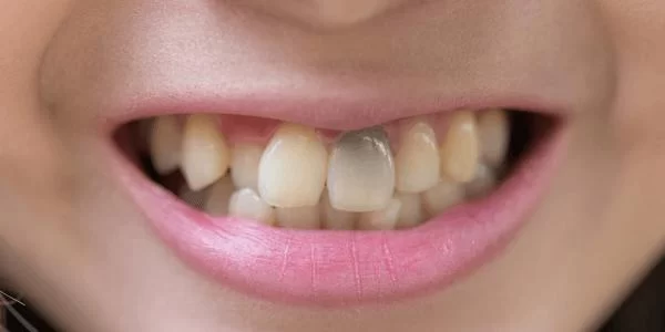 Can Smoking Cause Tooth Discoloration? Real Effects, Expert Insights, and Solutions