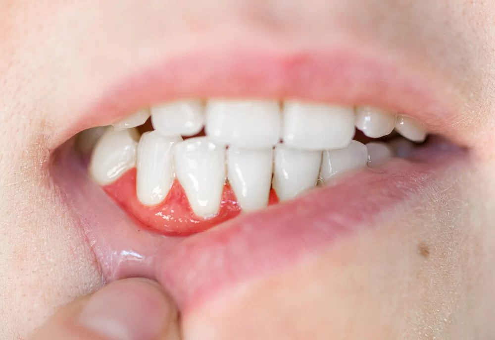 Effective Ways to Treat Dental Abscess Without Antibiotics: Safe Home Remedies and Care Tips