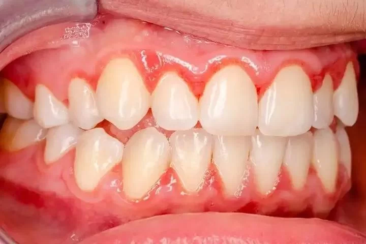 Understanding the Key Differences Between Gingivitis and Periodontitis for Better Oral Health