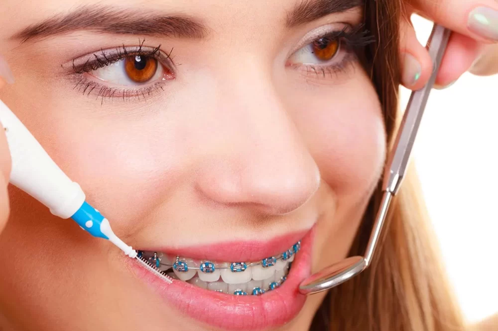How to Clean Dental Braces Effectively: Step-by-Step Guide, Stories, and Expert Tips