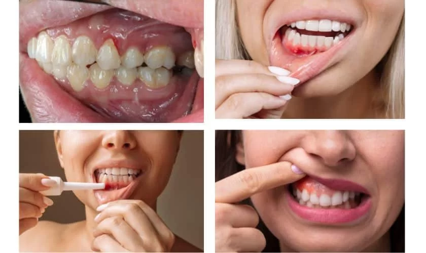 Effective Strategies on How to Reverse Early Gum Disease for Healthy Gums