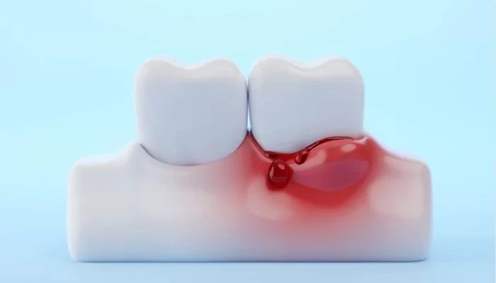 How to Heal Gums After Deep Cleaning: Expert Advice for Healthy Recovery