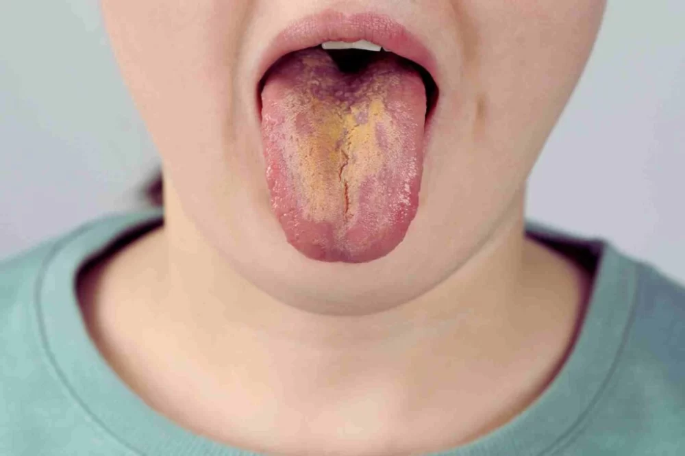 How to Treat Oral Thrush in Adults Naturally: Effective Home Remedies and Practical Advice