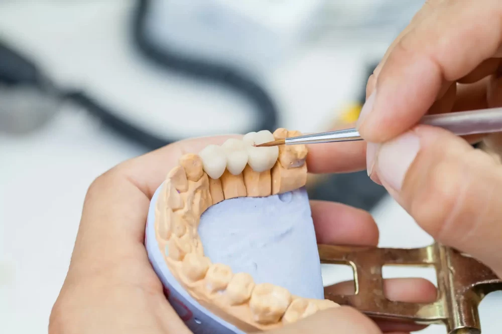 How to Care for Dental Bridges Properly: Pro Tips, Stories, and Step-by-Step Guidance