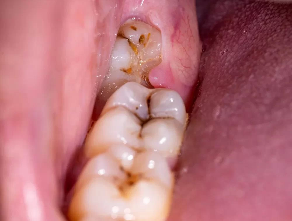 Common Symptoms of Wisdom Tooth Infection and How to Treat Them