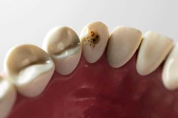 How to Treat an Abscessed Tooth Naturally: Effective Home Remedies and Tips