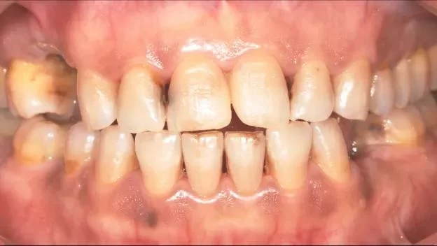 How to Identify Early Signs of Tooth Decay and Prevent Further Damage