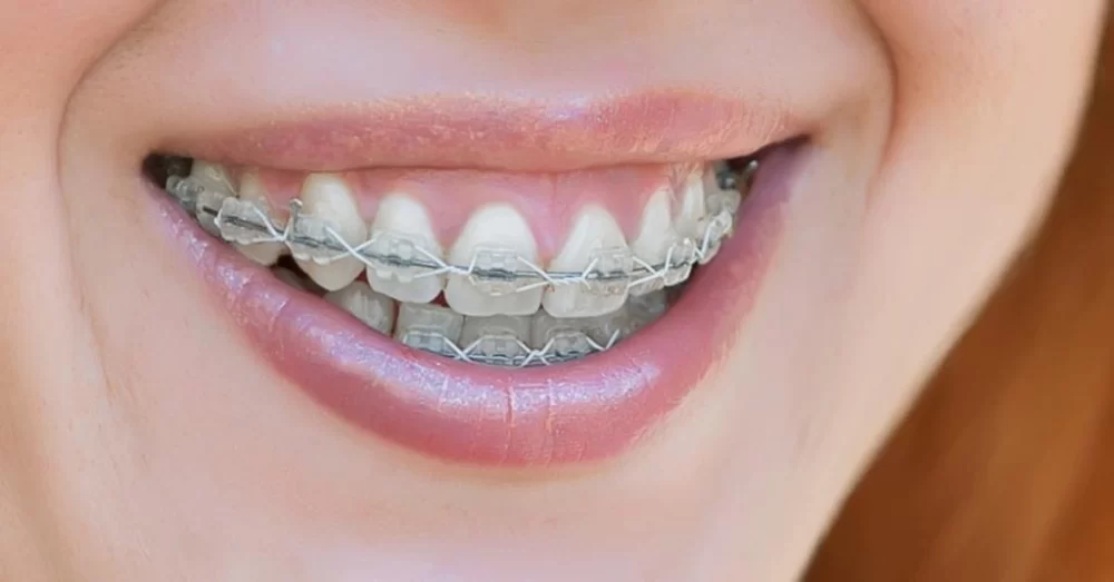 Effects of Orthodontic Treatment on Oral Health: A Comprehensive Guide