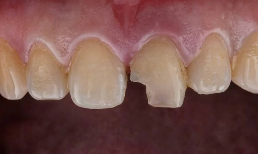 How to Deal with a Chipped Tooth: Effective Solutions and Tips