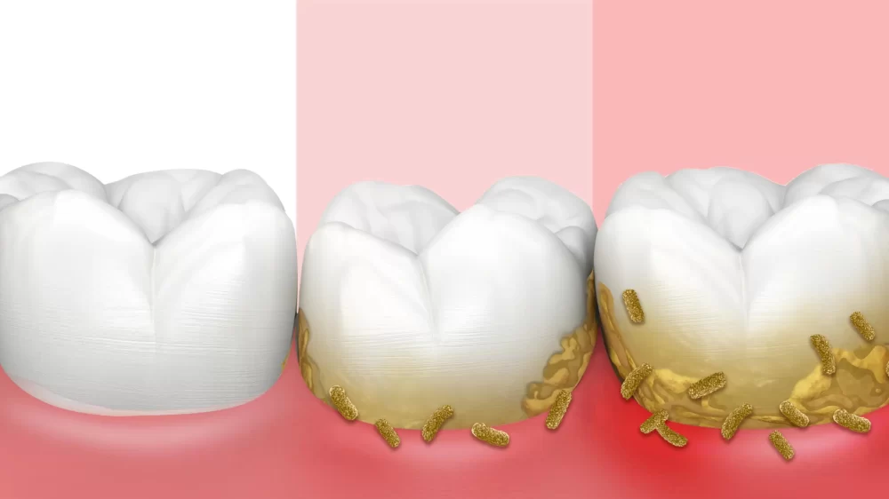 How to Avoid Gum Disease with Proper Oral Care
