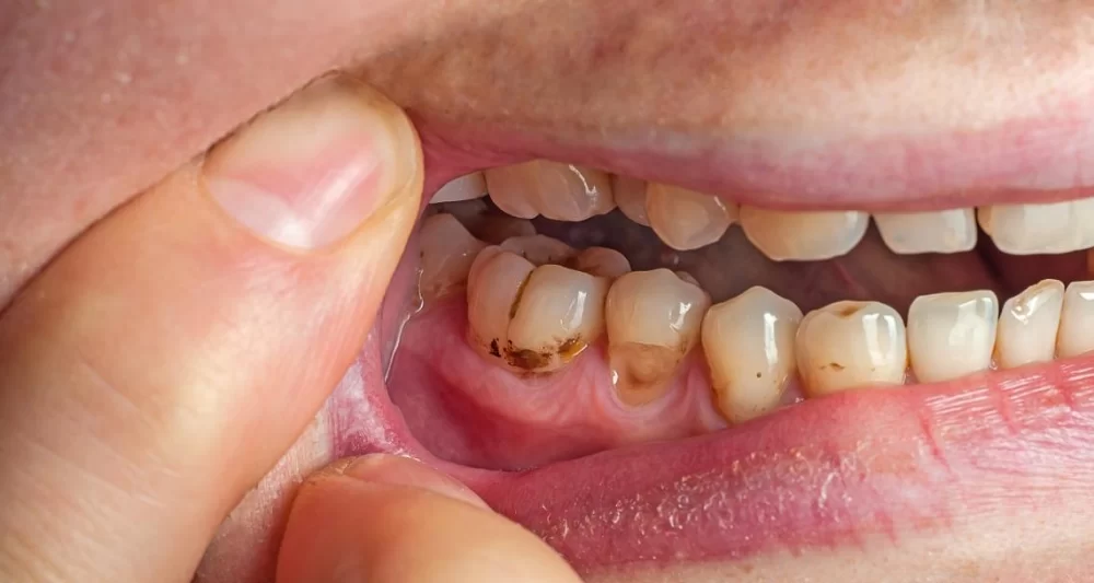 How to Treat Tooth Pain Caused by Sinus Infection: Effective Solutions