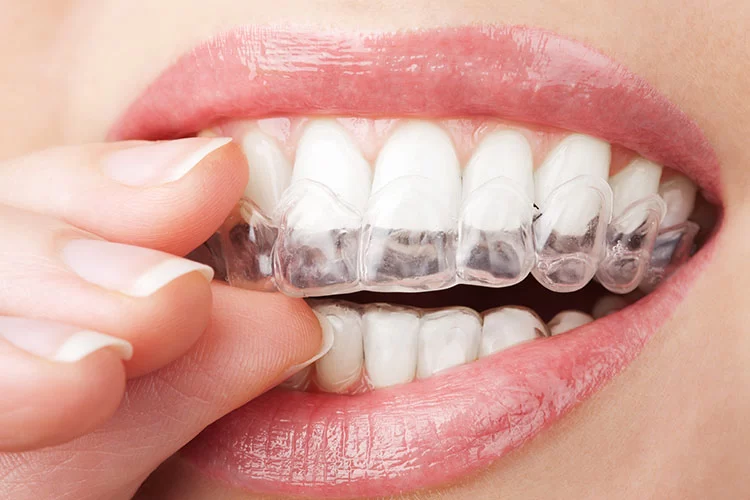 The Benefits of Mouth Guards for Teeth Grinding