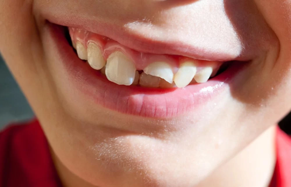 What to Do If You Have a Chipped Tooth: Effective Steps and Expert Advice