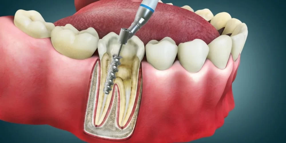 Recognizing Signs That You May Need a Root Canal Treatment
