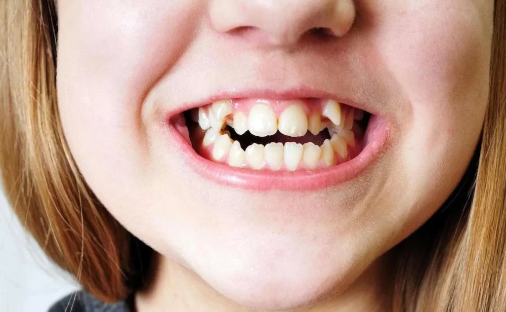 Effects of Jaw Misalignment on Teeth and Gums: Understanding the Impact