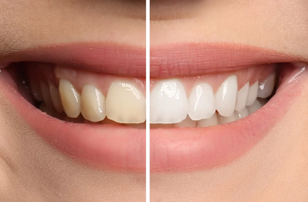 Effects of Teeth Whitening on Sensitive Teeth