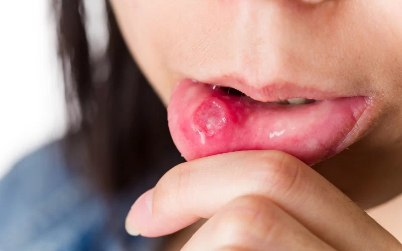 The Effects of Poor Oral Hygiene on General Health