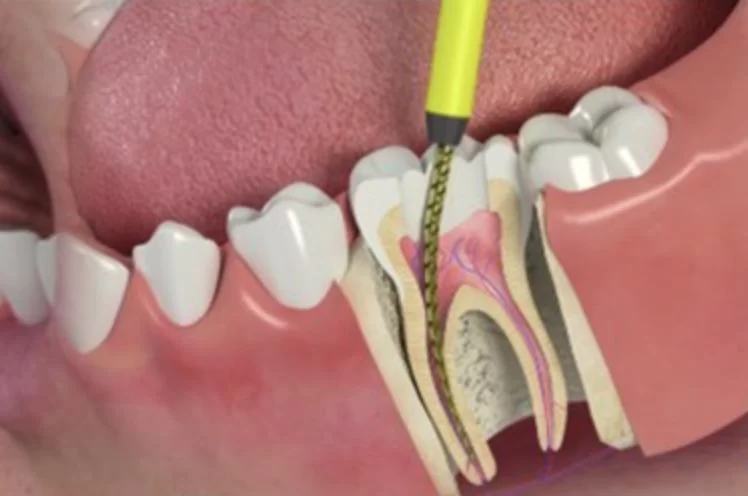 How to Treat a Tooth Abscess with Antibiotics