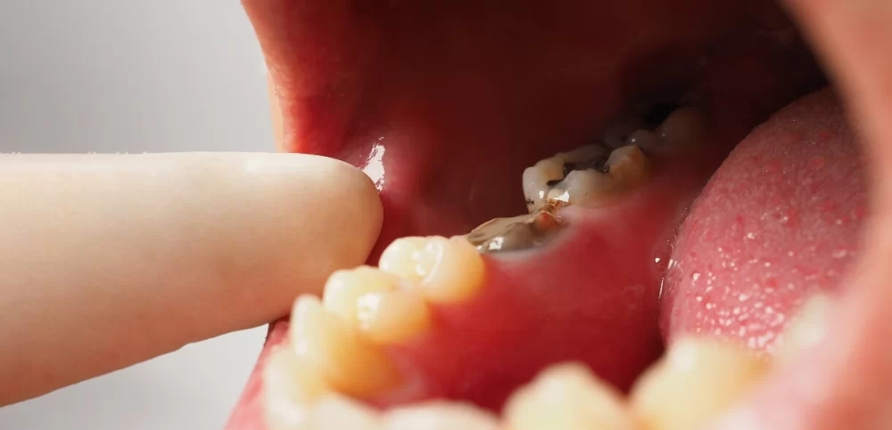 How to Effectively Treat a Toothache Caused by a Wisdom Tooth