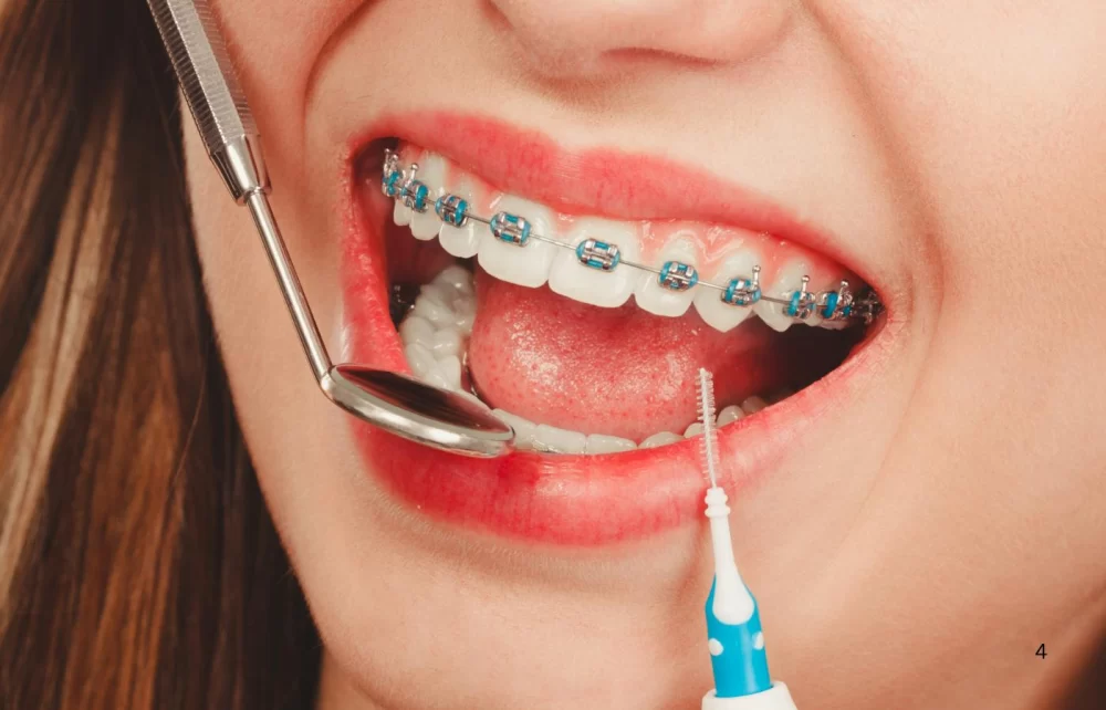 How to Prevent Tooth Decay in People with Braces: Essential Tips for Healthy Teeth