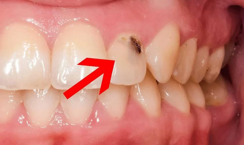How to Prevent Tooth Decay in People with Dry Mouth