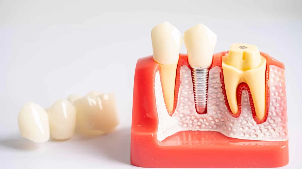 Understanding the Importance of Dental Implants for Long-Term Oral Health