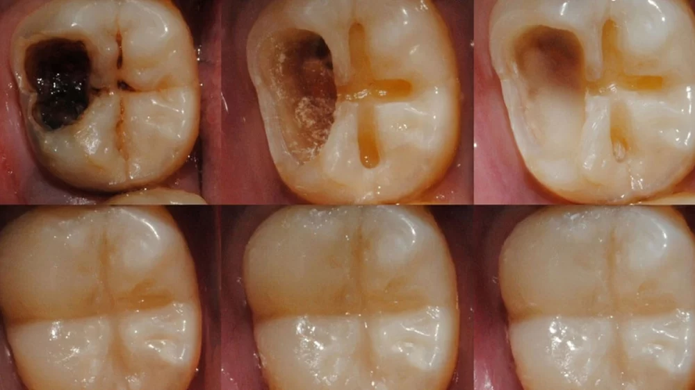 Can Tooth Enamel Be Repaired Naturally or Professionally?