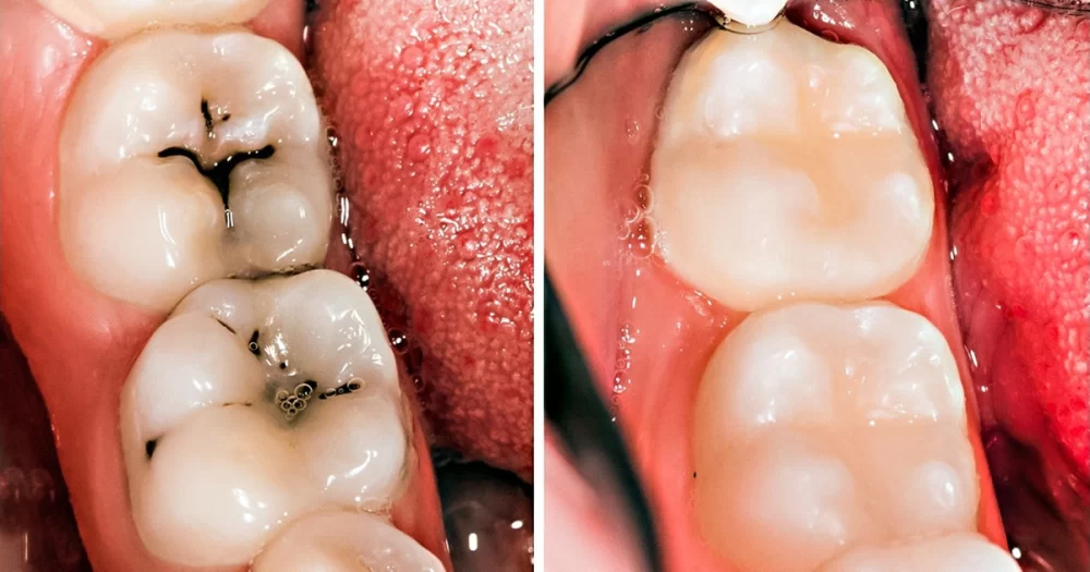 How to Prevent Cavities Naturally with Proven Tips and Real-Life Examples