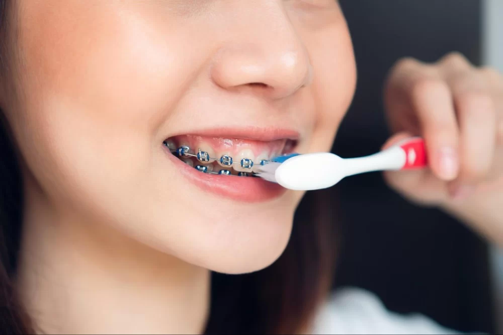 Tips for Brushing Your Teeth with Braces the Right Way
