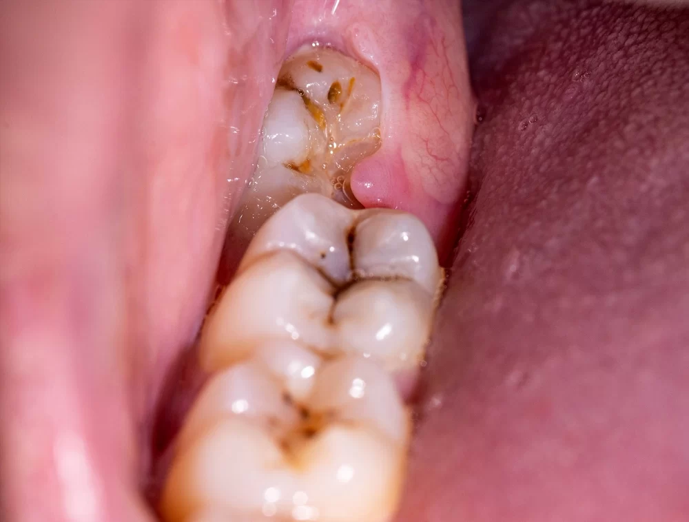 Understanding Symptoms of Wisdom Tooth Infection and How to Manage Them