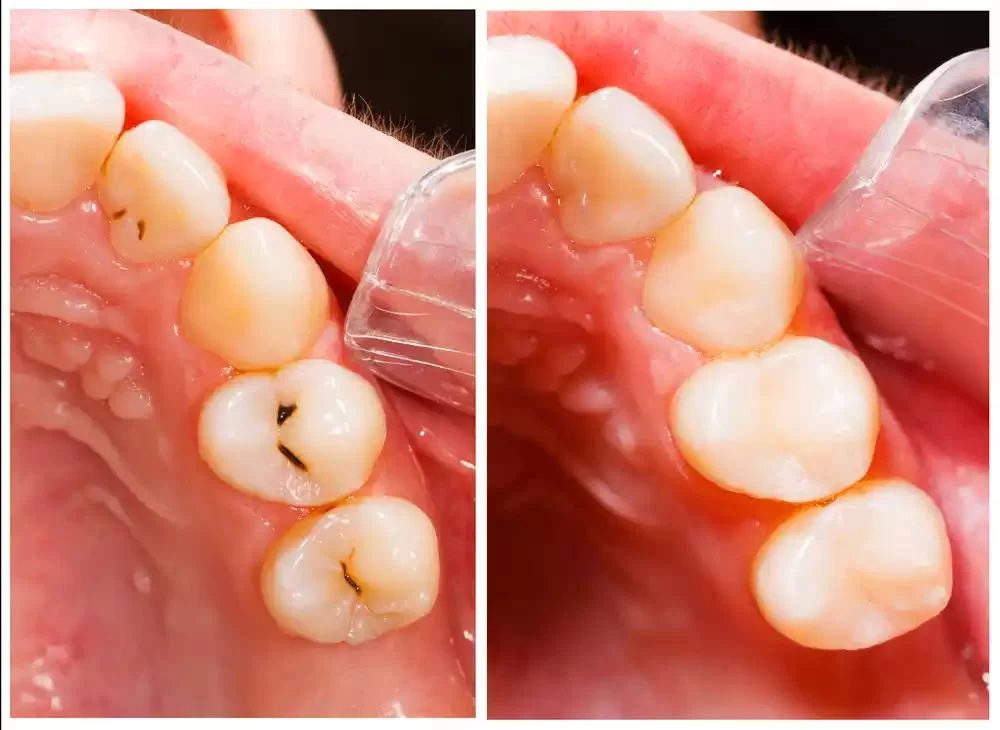Understanding Causes of Tooth Sensitivity After Filling and How to Manage It