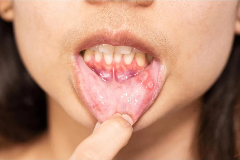 Understanding the Causes of White Patches Inside Mouth and How to Address Them