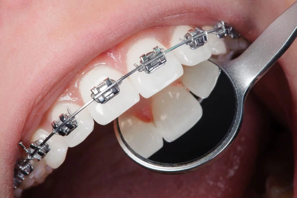 Effective Strategies to Prevent Gum Disease and Maintain Oral Health After Orthodontic Treatment