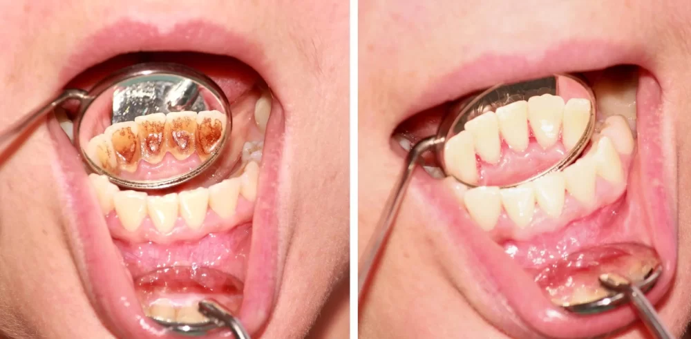 How to Treat Gum Inflammation After Dental Cleaning Effectively
