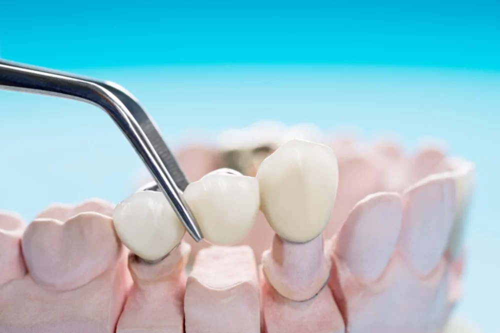 How to Care for Dental Bridges After Placement: Essential Tips for Long-Lasting Results