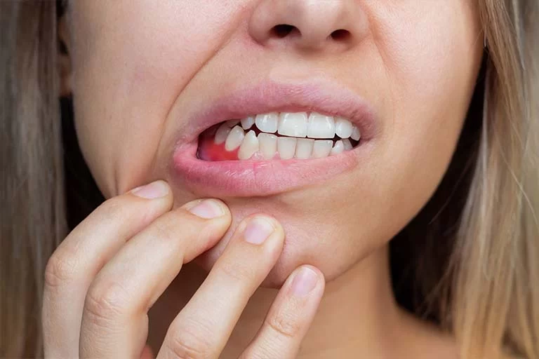 How to Stop Bleeding Gums Naturally: Effective Remedies and Tips for Healthy Gums