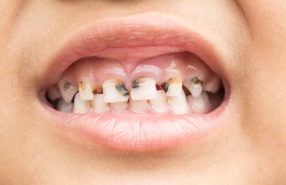 How to Treat Tooth Decay in Baby Teeth: Effective Strategies for Parents