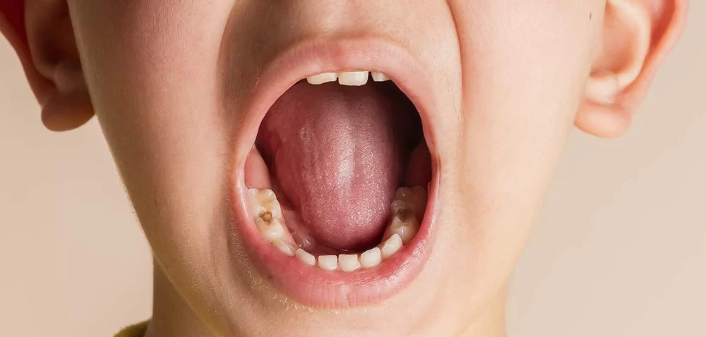 How to Prevent Tooth Decay with Sugar Substitutes: Effective Strategies and Insights